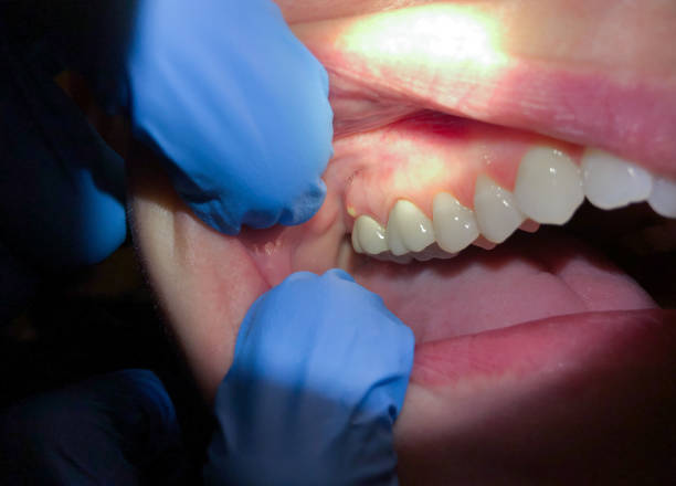 Best Emergency Dentist for Lost Fillings or Crowns in Gaithersburg, MD